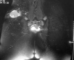 Gluteal bölgeye lokalize Alveolar yumuşak kısım sarkom MR görüntüsü