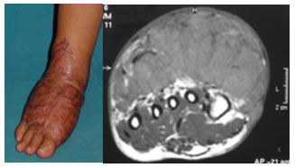 Ayak ve ayak bileğinde lokalize anjiosarkom olgusu klinik ve MR görüntüsü