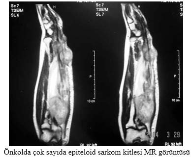 Ön kolda çok sayıda epiteloid sarkom kitlesi MR görüntüsü