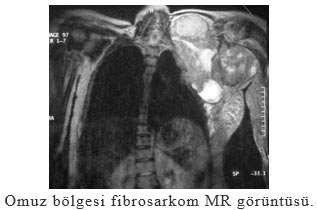 Omuz bölgesi fibrosarkom MR görüntüsü