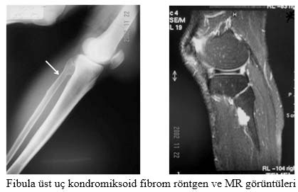 Kondromiksoid fibrom röntgen 