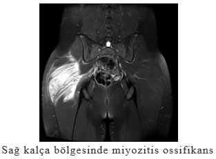 Sağ kalça bölgesinde miyozitis ossifikans