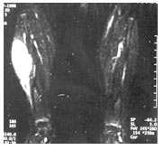 Bacak yerleşimli embriyonel rabdomiyosarkom MR görüntüsü