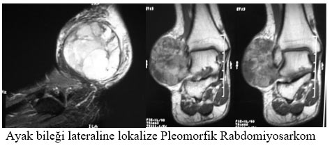 Ayak bileği lateraline lokalize Pleomorfik Rabdomiyosarkom