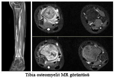 Tibi osteomyelit MR görüntüsü