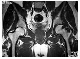 Sol kalça pigmente villonodüler sinovit olgusunun MR görüntüsü
